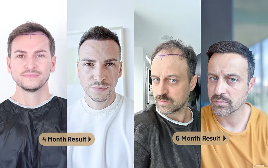 Before and after photos of hair transplant results, showing one man's progress at 4 months and another man's progress at 6 months, demonstrating successful hair restoration.